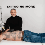 Tattoo laten verwijderen